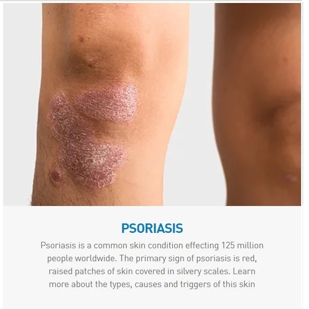 CeraVe Cleanser for Psoriasis Treatment